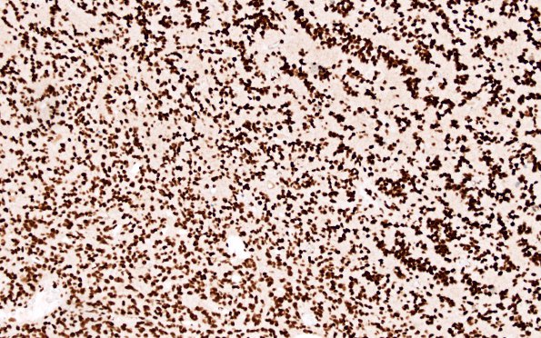 2C2 Oligodendroglioma, Anaplastic Grade 3 (Case 2) ATRX 1