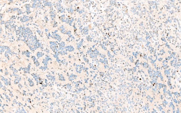 2D2 Oligodendroglioma, Anaplastic Grade 3 (Case 2) p53 5