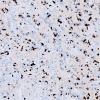 2E2 Oligodendroglioma, Anaplastic Grade 3 (Case 2) Ki67 2