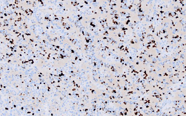 2E2 Oligodendroglioma, Anaplastic Grade 3 (Case 2) Ki67 2