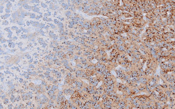 2F2 Oligodendroglioma, Anaplastic Grade 3 (Case 2) SYN 3