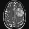 3A1 Oligodendroglioma, anaplastic, WHO Grade 3 (S12-2418) T2 - Copy