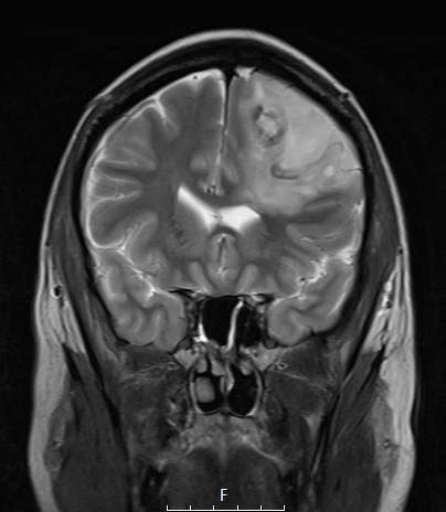 3A2 Oligodendroglioma, anaplastic, WHO Grade 3 (Case 3) MRI T2 coronal 1A.jpg - Copy