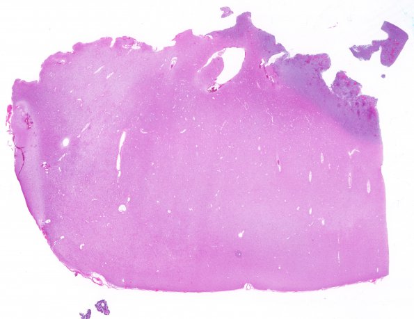 3B1 Oligodendroglioma, anaplastic, WHO Grade 3 (Case 3) H&E WM