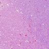 3B2 Oligodendroglioma, anaplastic, WHO Grade 3 (Case 3) H&E 19