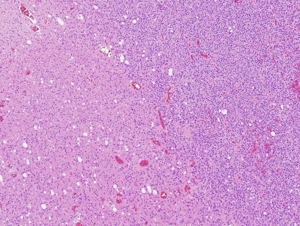 3B2 Oligodendroglioma, anaplastic, WHO Grade 3 (Case 3) H&E 19