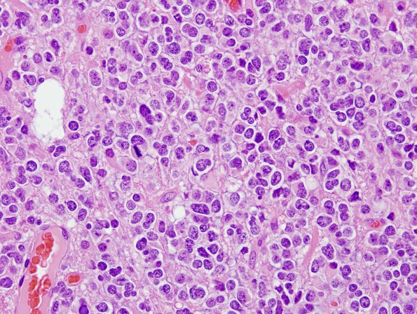 3B3 Oligodendroglioma, anaplastic, WHO Grade 3 (Case 3) H&E 15