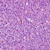 3B4 Oligodendroglioma, anaplastic, WHO Grade 3 (Case 3) H&E 12