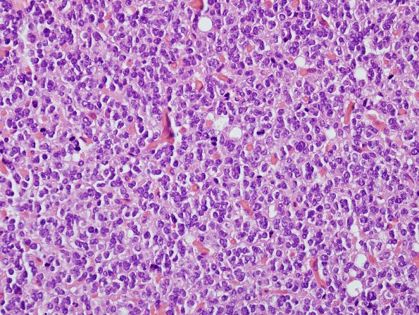 3B4 Oligodendroglioma, anaplastic, WHO Grade 3 (Case 3) H&E 12