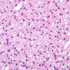 3B7 Oligodendroglioma, anaplastic, WHO Grade 3 (Case 3) H&E 10