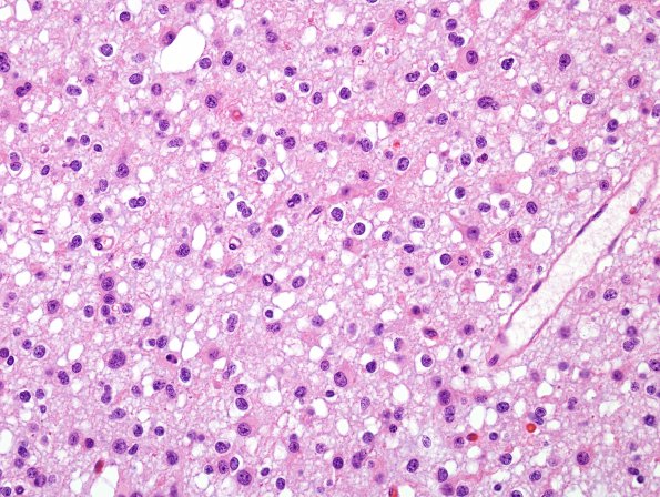 3B7 Oligodendroglioma, anaplastic, WHO Grade 3 (Case 3) H&E 10