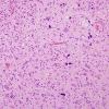 3B7 Oligodendroglioma, anaplastic, WHO Grade 3 (Case 3) H&E 3