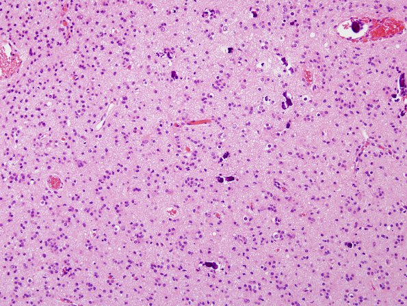 3B7 Oligodendroglioma, anaplastic, WHO Grade 3 (Case 3) H&E 3