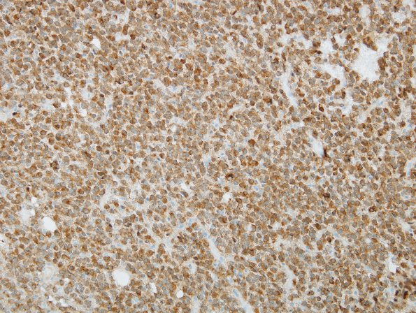 3D2 Oligodendroglioma, anaplastic, WHO Grade 3 (Case 3) IDH1 5