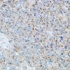 3F Oligodendroglioma, anaplastic, WHO Grade 3 (Case 3) SYN 6