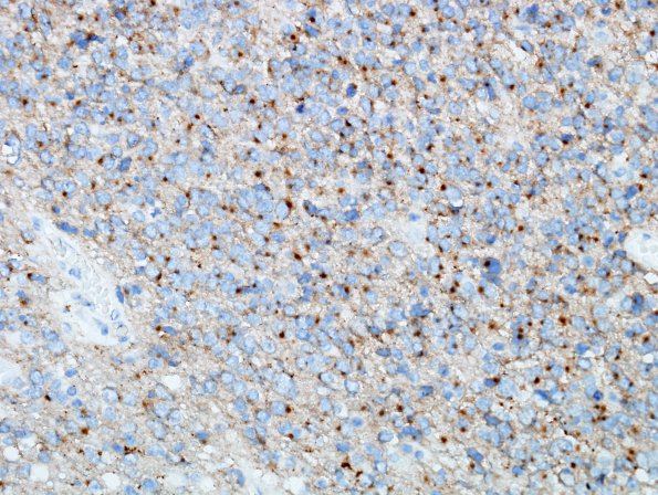 3F Oligodendroglioma, anaplastic, WHO Grade 3 (Case 3) SYN 6