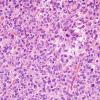 4A1 Oligodendroglioma, anaplastic WHO Grade 3, Case 4) H&E 2