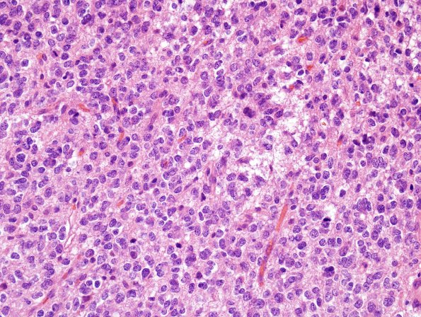 4A1 Oligodendroglioma, anaplastic WHO Grade 3, Case 4) H&E 2