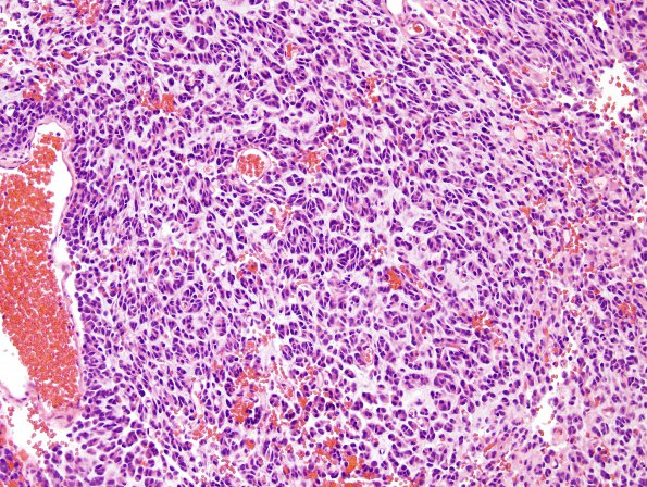 4A2 Oligodendroglioma, anaplastic WHO Grade 3, Case 4) H&E 5