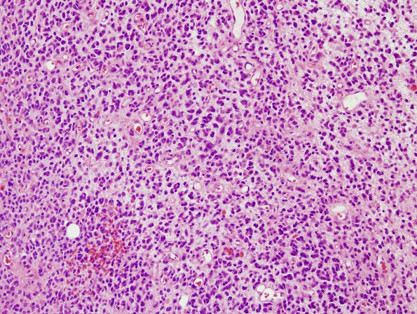 4A3 Oligodendroglioma, anaplastic WHO Grade 3, Case 4) H&E 6