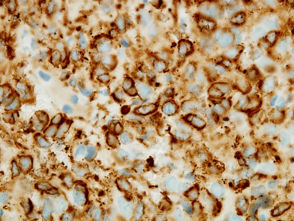 4B2 Oligodendroglioma, anaplastic WHO Grade 3, Case 4) 100X GFAP 2