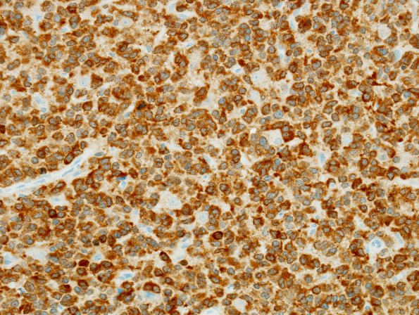 4C1 Oligodendroglioma, anaplastic WHO Grade 3, Case 4) IDH1 2