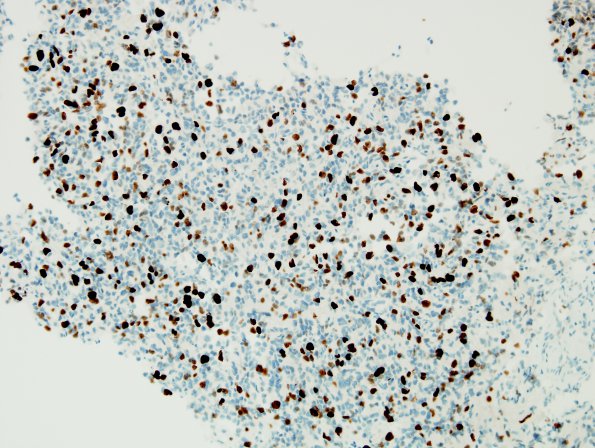 4D Oligodendroglioma, anaplastic WHO Grade 3, Case 4) MIB