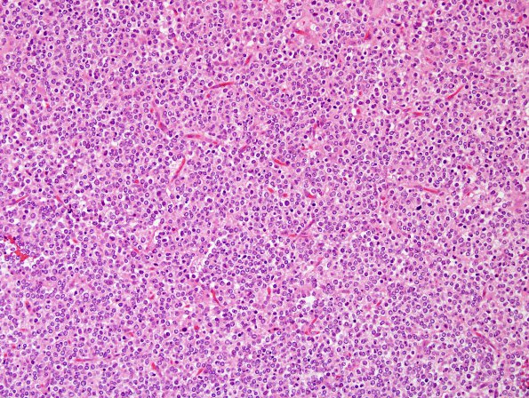 5A1 Oligodendroglioma, anaplastic, Grade 3 (Case 5) H&E 12.jpg