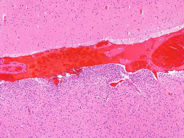 5A2 Oligodendroglioma, anaplastic, Grade 3 (Case 5) H&E 7.jpg