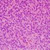 5A3 Oligodendroglioma, anaplastic, Grade 3 (Case 5) H&E 2.jpg