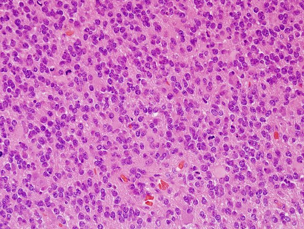 5A3 Oligodendroglioma, anaplastic, Grade 3 (Case 5) H&E 2.jpg