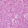 5A4 Oligodendroglioma, anaplastic, Grade 3 (Case 5) H&E 10.jpg