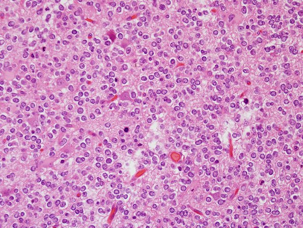 5A4 Oligodendroglioma, anaplastic, Grade 3 (Case 5) H&E 10.jpg