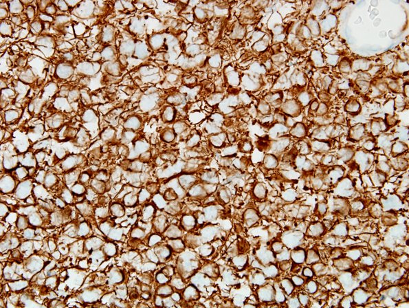 5B2 Oligodendroglioma, anaplastic, Grade 3 (Case 5) GFAP gliofibrillary oligo 1.jpg