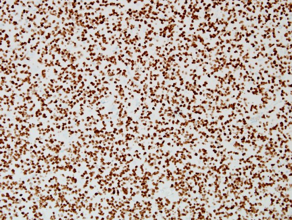 5C Oligodendroglioma, anaplastic, Grade 3 (Case 5) Olig2.jpg