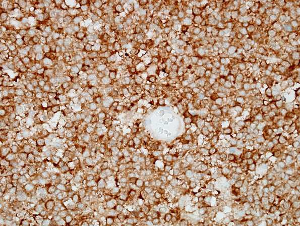 5D Oligodendroglioma, anaplastic, Grade 3 (Case 5) IDH1 2.jpg