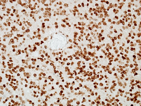 5E Oligodendroglioma, anaplastic, Grade 3 (Case 5) ATRX 1 end.jpg