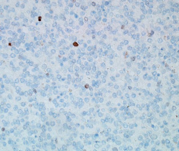 5F Oligodendroglioma, anaplastic, Grade 3 (Case 5) p53 2.jpg