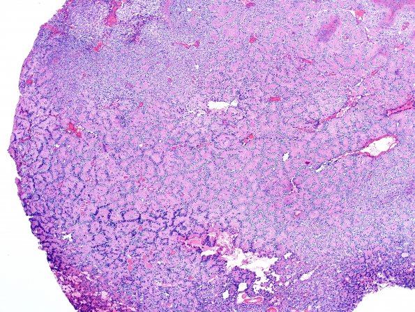 6A2 Oligodendroglioma, Gr3 & neurocytic (Case 6) H&E 8