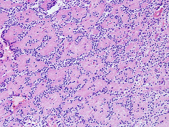 6A3 Oligodendroglioma, Gr3 & neurocytic (Case 6) H&E 6