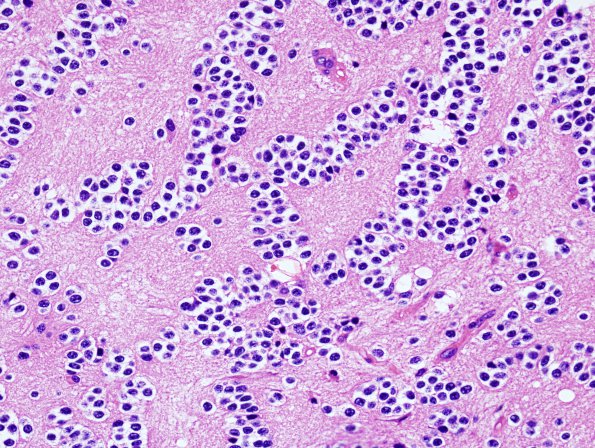 6A4 Oligodendroglioma, Gr3 & neurocytic (Case 6) H&E 5