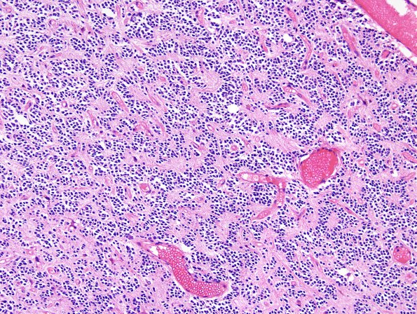 6A5 Oligodendroglioma, Gr3 & neurocytic (Case 6) H&E 2