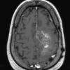 7A1 Oligodendroglioma, anaplastic Grade 3 (Case 7) T1 W - Copy