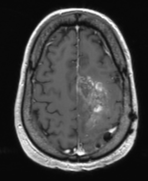 7A1 Oligodendroglioma, anaplastic Grade 3 (Case 7) T1 W - Copy