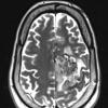 7A2 Oligodendroglioma, anaplastic Grade 3 (Case 7) T2 W - Copy