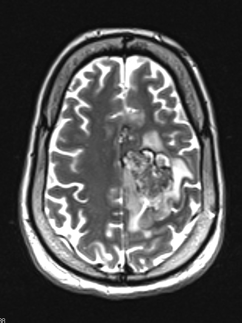 7A2 Oligodendroglioma, anaplastic Grade 3 (Case 7) T2 W - Copy