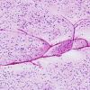 7B1 Oligodendroglioma, anaplastic Grade 3 (Case 7) H&E 12