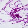 7B2 Oligodendroglioma, anaplastic Grade 3 (Case 7) H&E 17