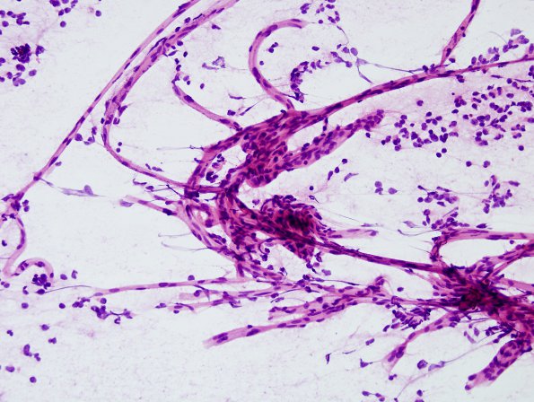 7B2 Oligodendroglioma, anaplastic Grade 3 (Case 7) H&E 17