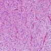 7B3 Oligodendroglioma, anaplastic Grade 3 (Case 7) H&E 1